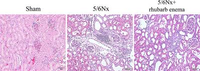 Rhubarb Enema Improved Colon Mucosal Barrier Injury in <mark class="highlighted">5/6 Nephrectomy</mark> Rats May Associate With Gut Microbiota Modification